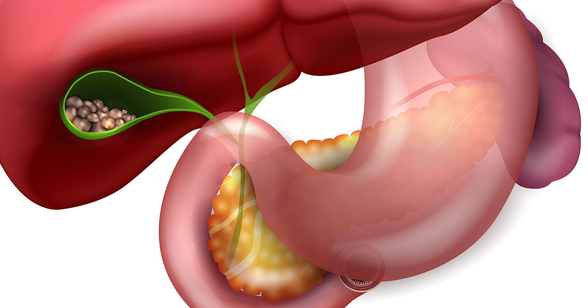 67367357 - gallstones in the gallbladder and anatomy of surrounding organs.
